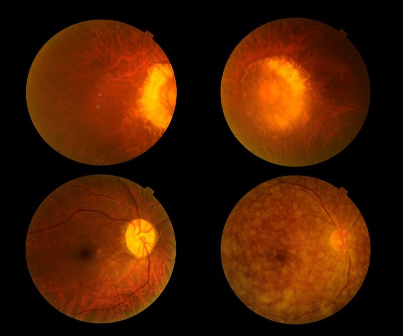 Retina durante o exame do fundo ocular